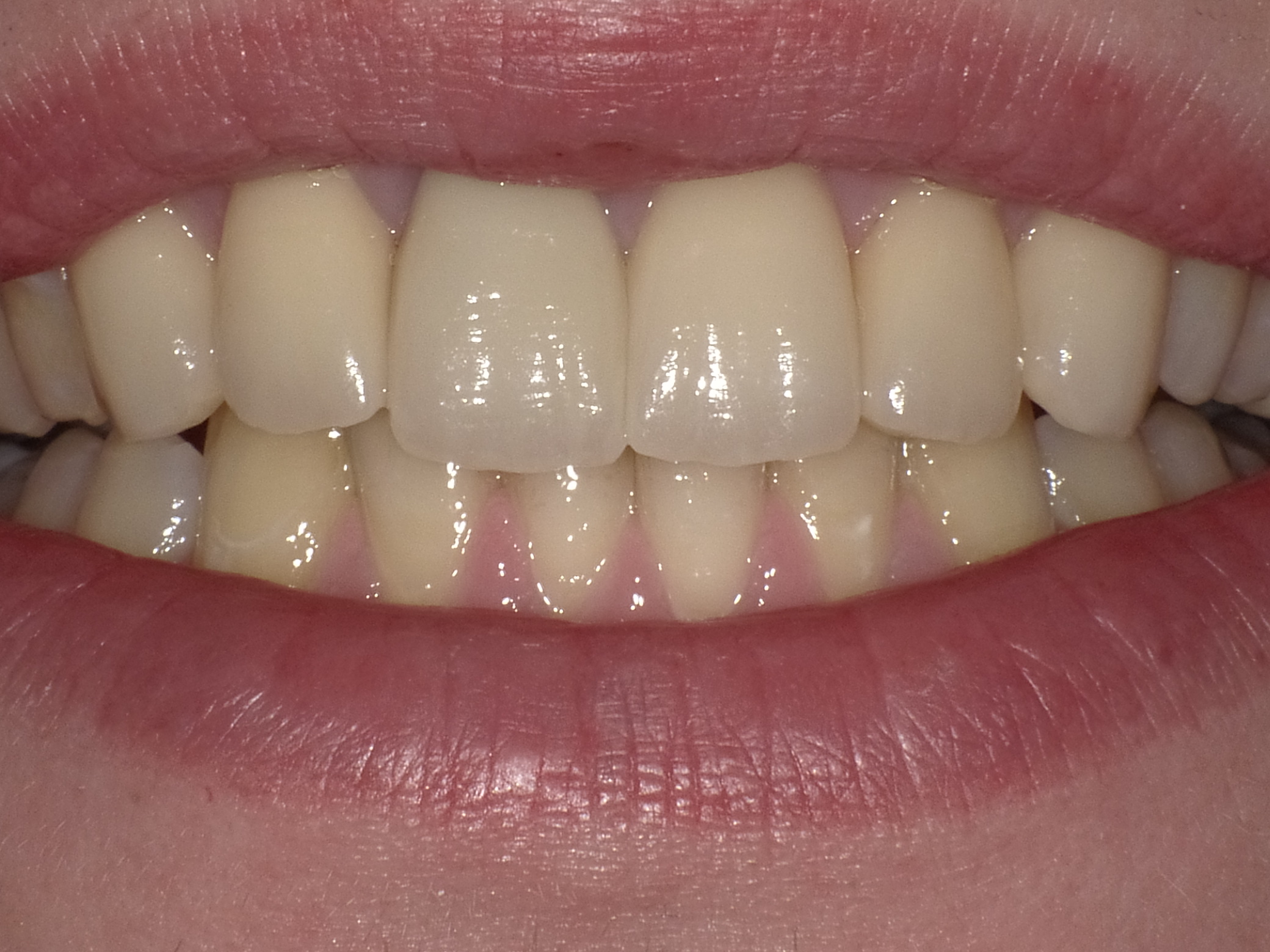 Ästhethische Optimierung mit Veneers und Kronen aus Vollkeramik